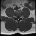 Normal lumbar spine MRI (Radiopaedia 35543-37039 Axial T1 20).png