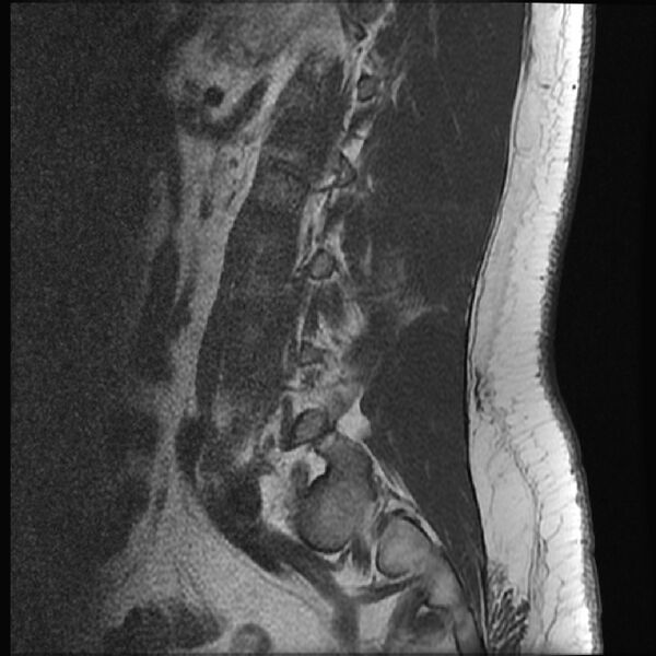 File:Normal lumbar spine MRI (Radiopaedia 43051-46311 Sagittal T1 4).jpg