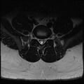 Normal lumbar spine MRI (Radiopaedia 47857-52609 Axial T2 26).jpg