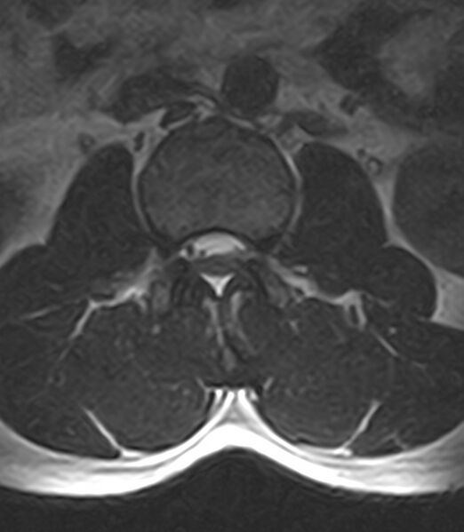 File:Normal lumbar spine MRI - low-field MRI scanner (Radiopaedia 40976-43699 Axial T2 36).jpg