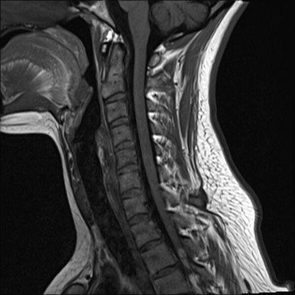 File:Normal trauma cervical spine MRI (Radiopaedia 32130-33071 Sagittal T1 7).jpg