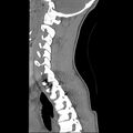 Normal trauma spine imaging (age 16) (Radiopaedia 45335-49358 C 11).jpg