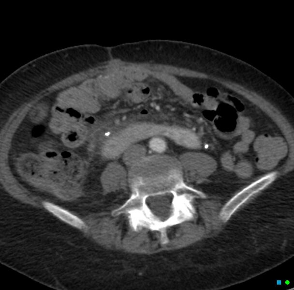 File:Obstructed infected horseshoe kidney (Radiopaedia 18116-17898 B 24).jpg