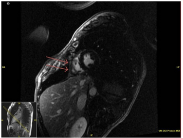 Pericardial enhancement of right ventricular free wall on cardiac MRI consistent with acute pericarditis.
