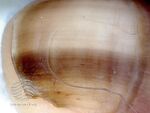 Racial melanonychia (DermNet NZ hair-nails-sweat-melanonychia-13).jpg