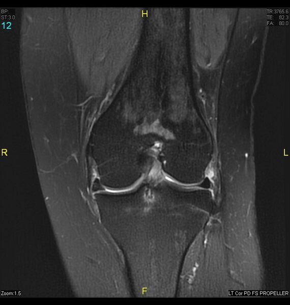 File:ACL mucoid degeration with cystic changes (Radiopaedia 48428-53341 Coronal PD fat sat 9).jpg