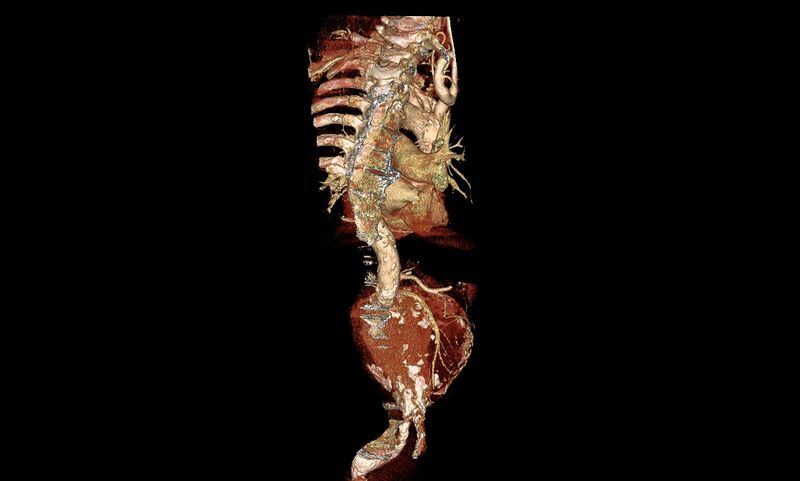 File:Abdominal aortic aneurysm- extremely large, ruptured (Radiopaedia 19882-19921 3D 16).jpg