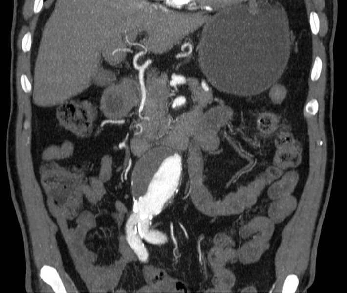 File:Abdominal aortic aneurysm (Radiopaedia 22421-22458 C 15).jpg