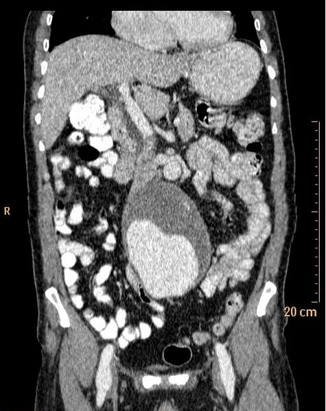 File:Abdominal aortic aneurysm (Radiopaedia 25985-26121 Coronal C+ arterial phase 13).jpg