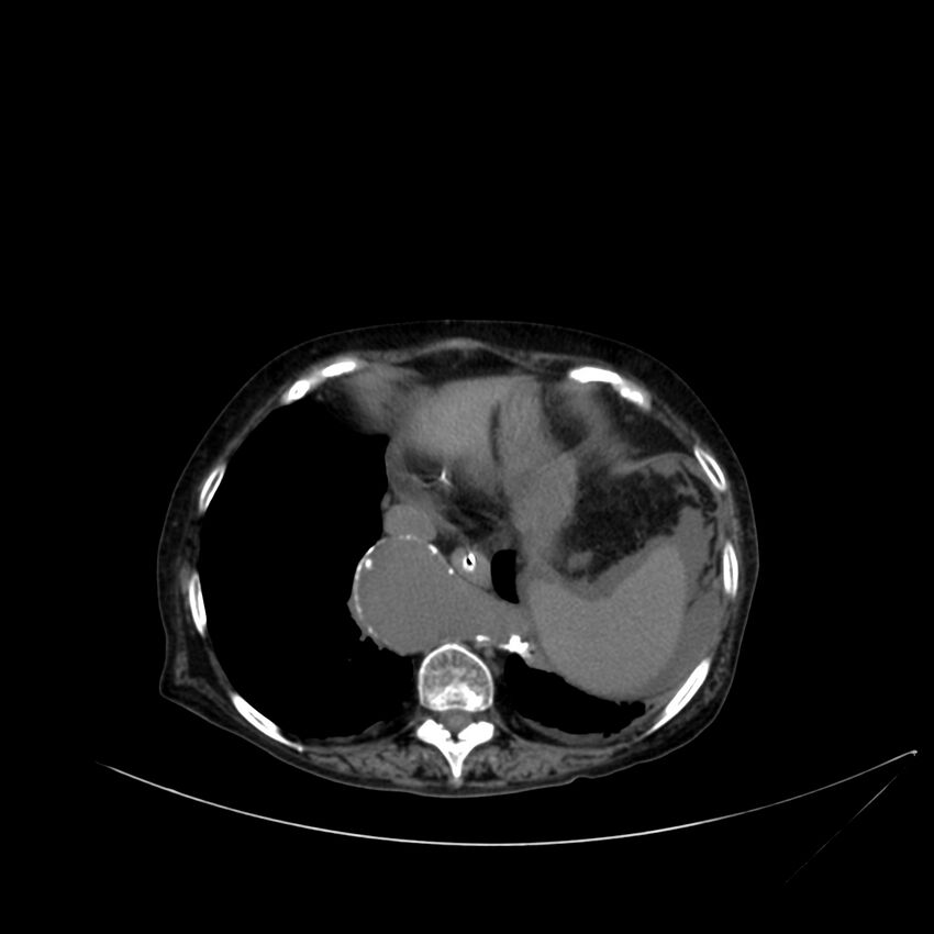 Abdominal aortic aneurysm - impending rupture (Radiopaedia 19233-19246 Axial non-contrast 21).jpg