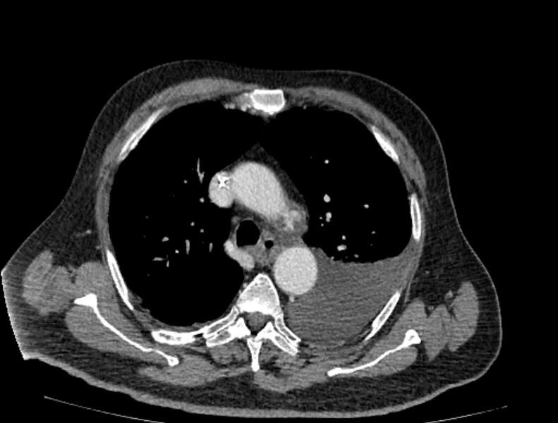 File:Abdominal aortic aneurysm rupture (Radiopaedia 54179-60362 Axial C+ portal venous phase 47).jpg