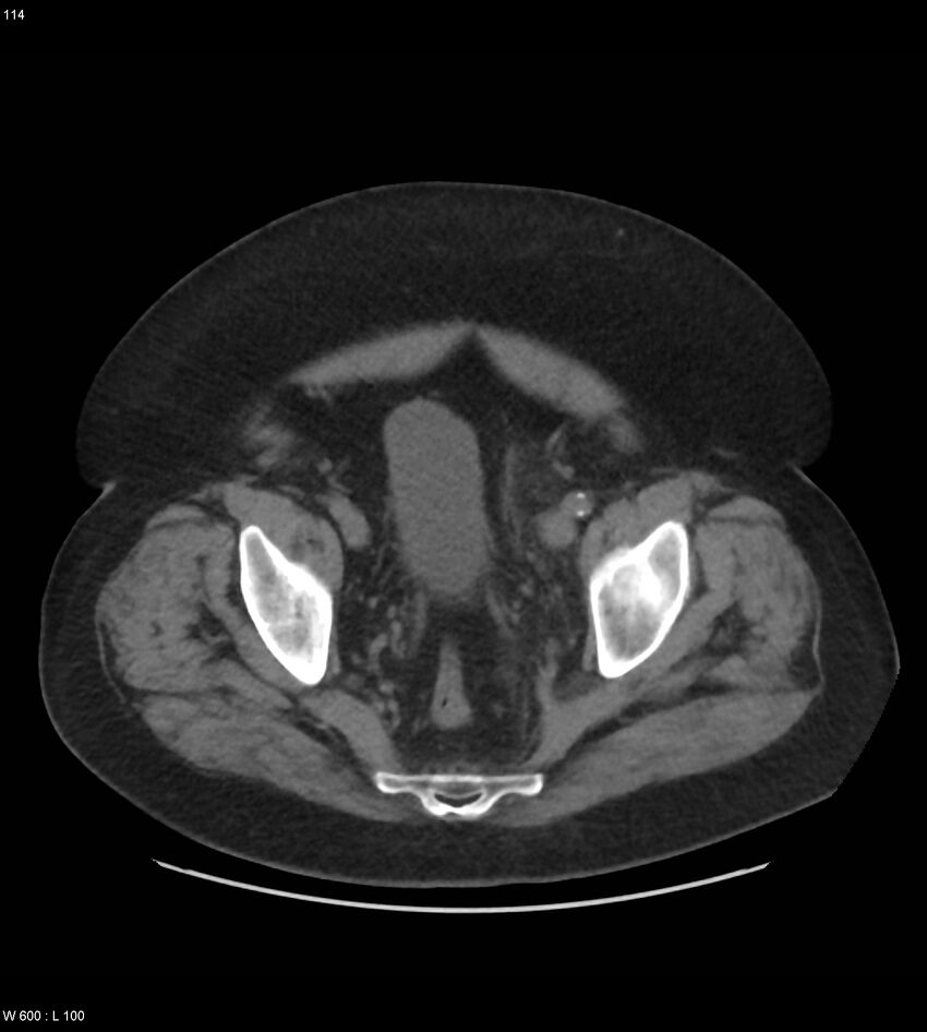 Abdominal aortic aneurysm with intramural hematoma then rupture (Radiopaedia 50278-55631 Axial non-contrast 110).jpg