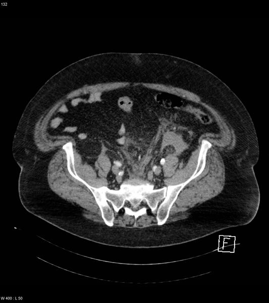 File:Abdominal aortic aneurysm with intramural hematoma then rupture (Radiopaedia 50278-55632 Axial C+ arterial phase 131).jpg