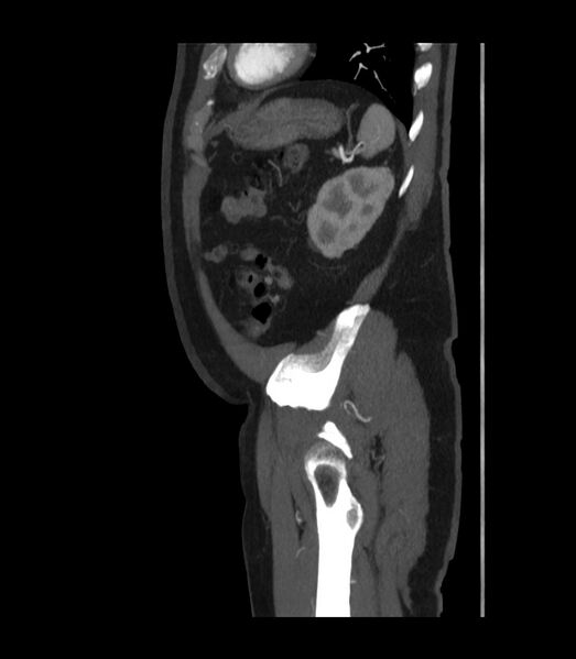File:Abdominal aortic aneurysm with thrombus fissuration (Radiopaedia 46218-50618 Sagittal C+ arterial phase 49).jpg