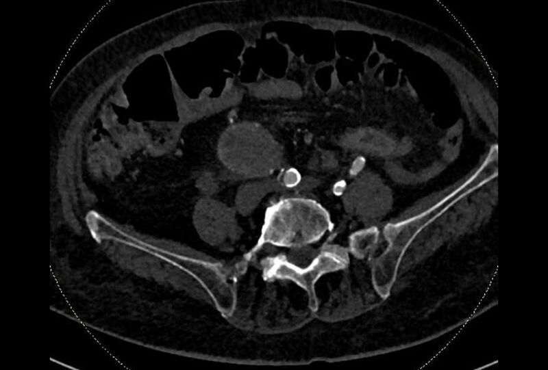 File:Abdominal aortic aneurysm with thrombus fissuration (Radiopaedia 73192-83919 Axial C+ arterial phase 148).jpg