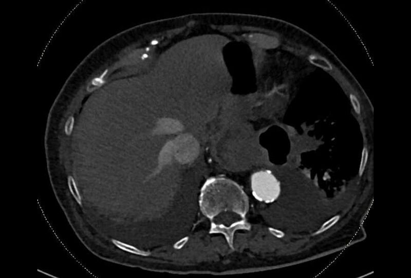 File:Abdominal aortic aneurysm with thrombus fissuration (Radiopaedia 73192-83919 Axial C+ arterial phase 6).jpg