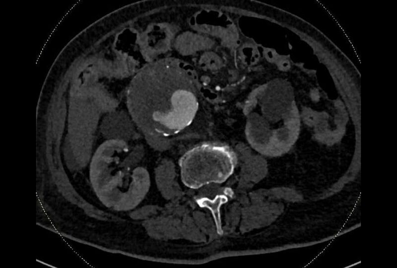 File:Abdominal aortic aneurysm with thrombus fissuration (Radiopaedia 73192-83919 Axial C+ arterial phase 95).jpg