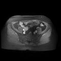 Abdominal wall endometriosis (Radiopaedia 83702-98847 Axial T1 C+ fat sat 21).jpg