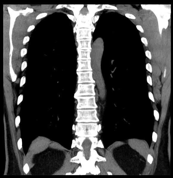 File:Aberrant right subclavian artery (Radiopaedia 40967-43680 Coronal non-contrast 32).jpg
