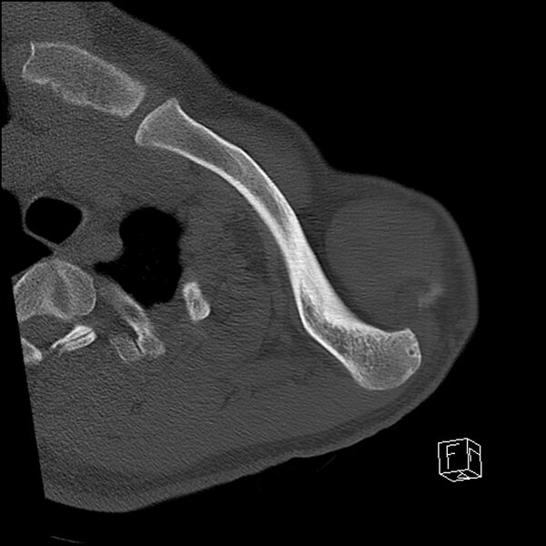 File:Acromioclavicular joint dissociation - type IV (Radiopaedia 64411-73216 Axial bone window 8).jpg