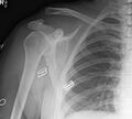 Acromioclavicular joint injury- grade 4 (Radiopaedia 49834-55104 Frontal 1).jpg