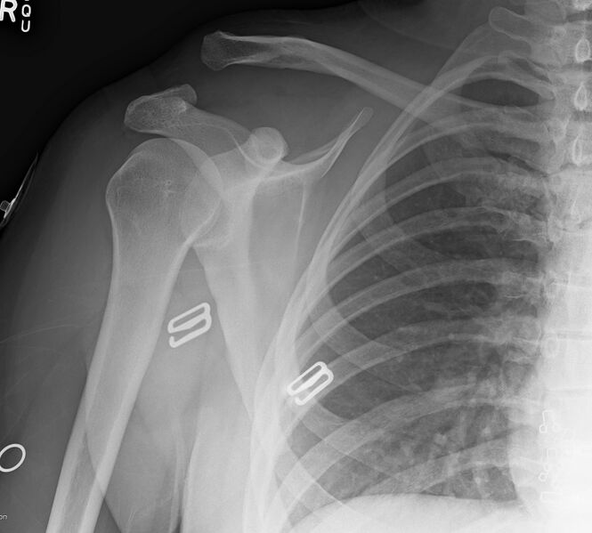 File:Acromioclavicular joint injury- grade 4 (Radiopaedia 49834-55104 Frontal 1).jpg