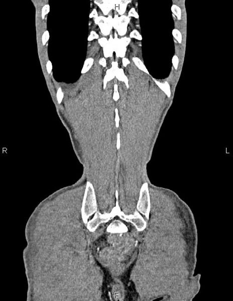 File:Active crohn disease (Radiopaedia 87133-103397 Coronal C+ arterial phase 60).jpg