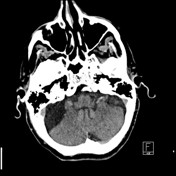 File:Acute ICA ischemic penumbra due to high-grade CCA stenosis (CT perfusion) (Radiopaedia 72038-82529 Axial non-contrast 9).jpg