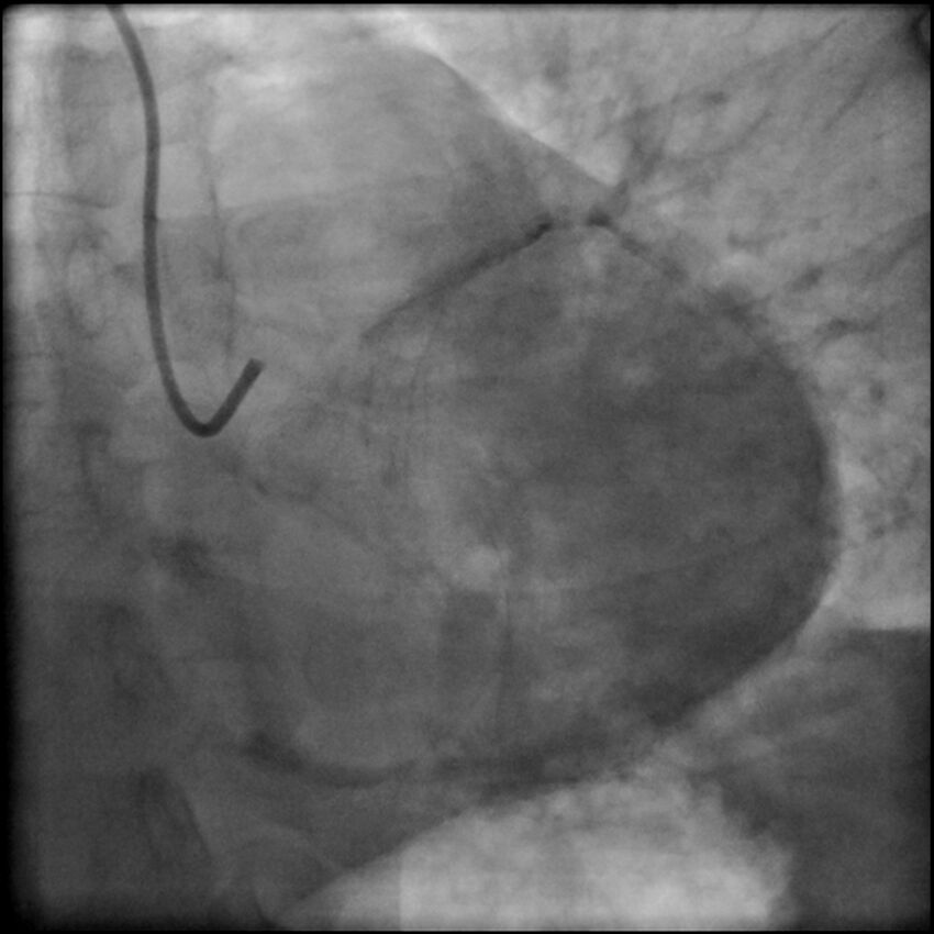 Acute anteroseptal myocardial infarction (Radiopaedia 68409-77946 LAO caudal (spider view) LAD and CX 84).jpg