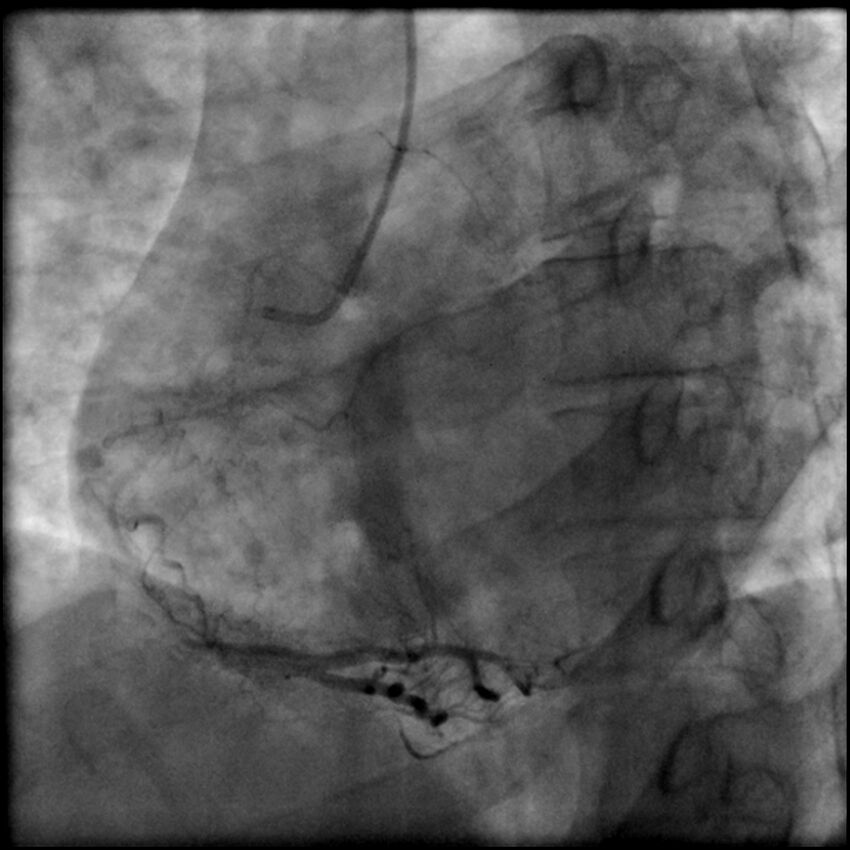 Acute anteroseptal myocardial infarction (Radiopaedia 68409-77946 RAO straight RCA 60).jpg