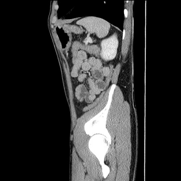 File:Acute appendicitis (Radiopaedia 27049-27227 Sagittal C+ portal venous phase 65).jpg