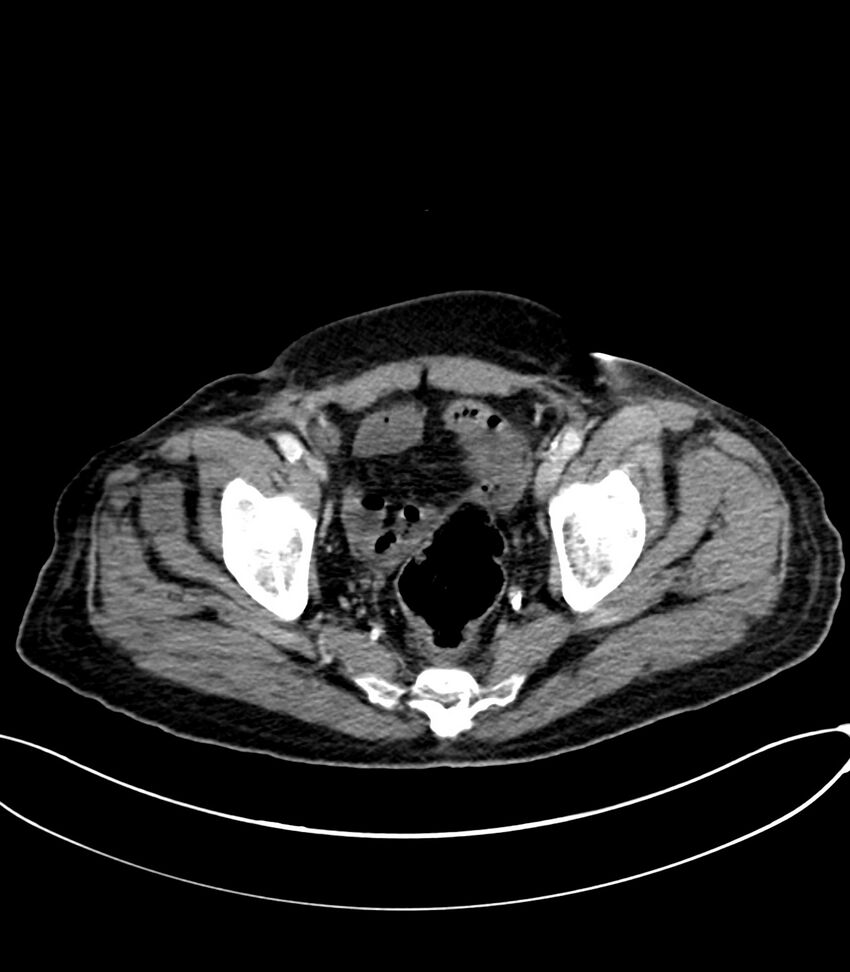 Acute arterial mesenteric ischemia (Radiopaedia 78238-90828 Axial C+ portal venous phase 125).jpg