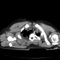 Acute aspiration pneumonitis (Radiopaedia 33605-34703 Axial non-contrast 22).jpg