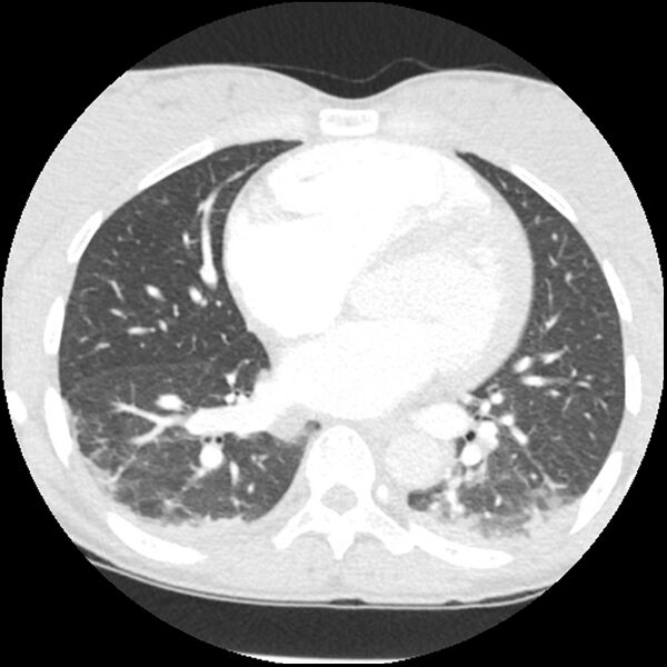 File:Acute chest syndrome - sickle cell disease (Radiopaedia 42375-45499 Axial lung window 113).jpg