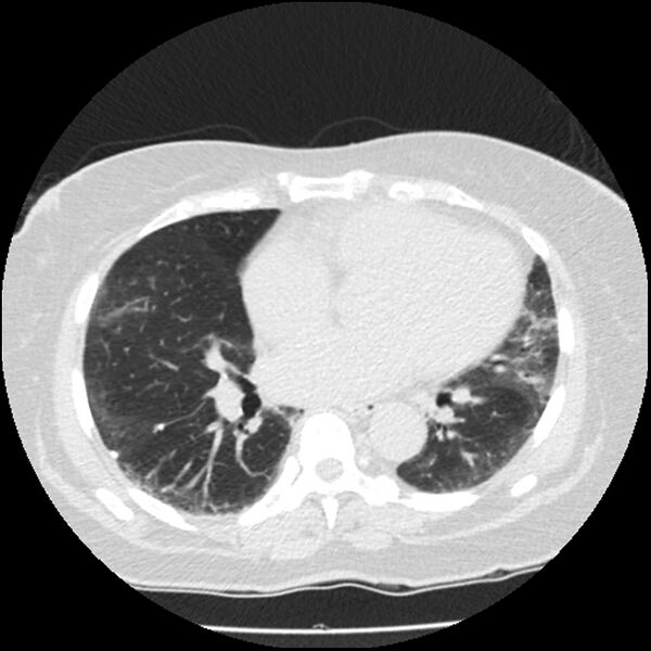 File:Acute interstitial pneumonitis (Radiopaedia 45404-49444 Axial lung window 63).jpg