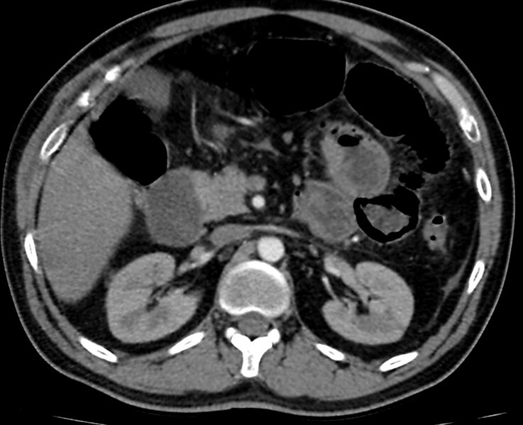 File:Acute mesenteric ischemia - superior mesenteric artery thrombosis (Radiopaedia 73947-84776 Axial C+ arterial phase 30).jpg