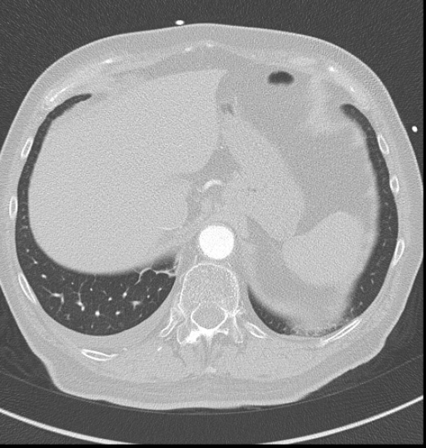 Acute myocardial infarction (Radiopaedia 23413-23481 lung window 66).jpg