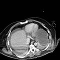 Acute pancreatic necrosis (Radiopaedia 13560-18501 Axial C+ portal venous phase 4).jpg