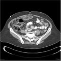 Acute pancreatitis (Radiopaedia 19136-19117 Axial C+ portal venous phase 30).jpg