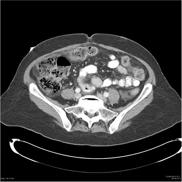 File:Acute pancreatitis (Radiopaedia 19136-19117 Axial C+ portal venous phase 30).jpg