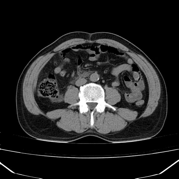 File:Acute pancreatitis (Radiopaedia 22572-22596 Axial non-contrast 36).jpg