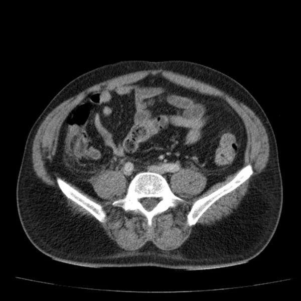 File:Acute pancreatitis (Radiopaedia 26663-26813 Axial C+ portal venous phase 59).jpg