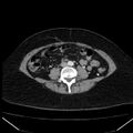 Acute pancreatitis - Balthazar C (Radiopaedia 26569-26714 Axial C+ arterial phase 58).jpg