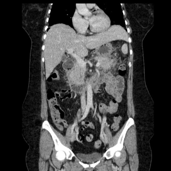 File:Acute pancreatitis - Balthazar C (Radiopaedia 26569-26714 Coronal C+ portal venous phase 32).jpg