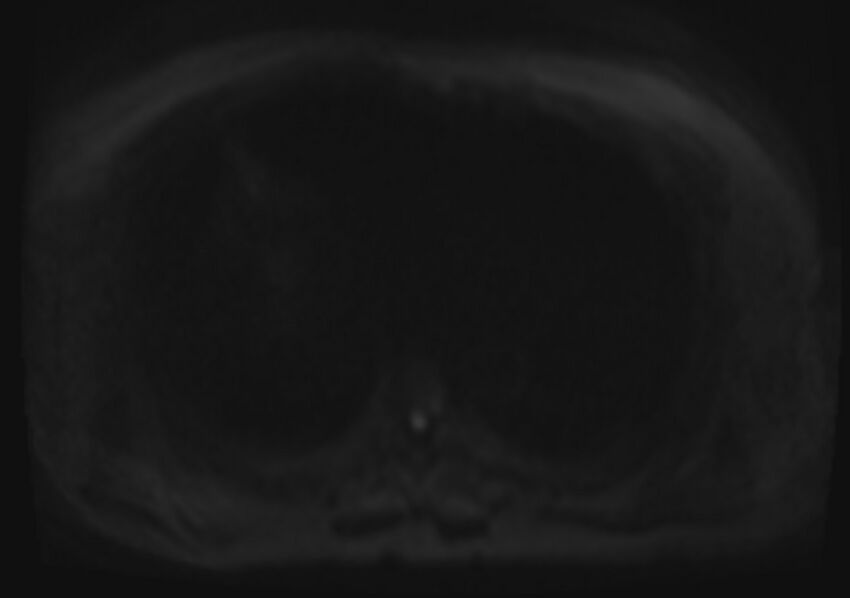 Acute portal vein thrombosis (Radiopaedia 73198-83925 Axial DWI 63).jpg