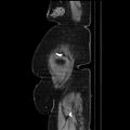 Acute pyelonephritis (Radiopaedia 25657-25837 Sagittal renal parenchymal phase 73).jpg