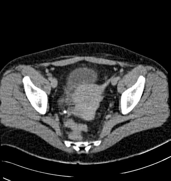 File:Acute pyelonephritis (Radiopaedia 40264-42816 Axial renal excretory phase 31).jpg
