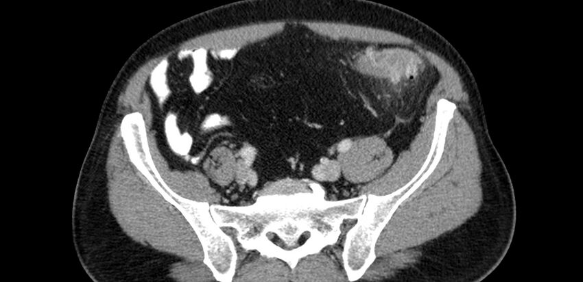 Acute sigmoid colon diverticulitis (Radiopaedia 55507-61976 Axial C+ portal venous phase 71).jpg