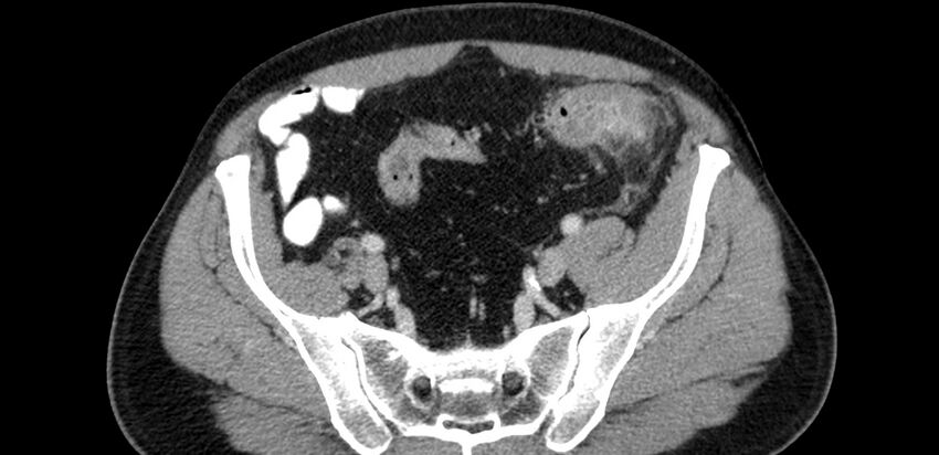 Acute sigmoid colon diverticulitis (Radiopaedia 55507-61976 Axial C+ portal venous phase 79).jpg