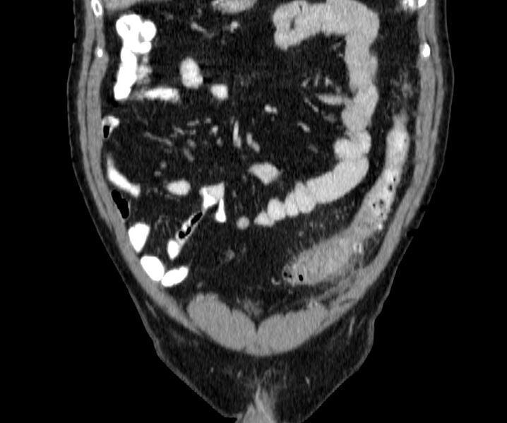 File:Acute sigmoid colon diverticulitis (Radiopaedia 55507-61976 Coronal C+ portal venous phase 30).jpg